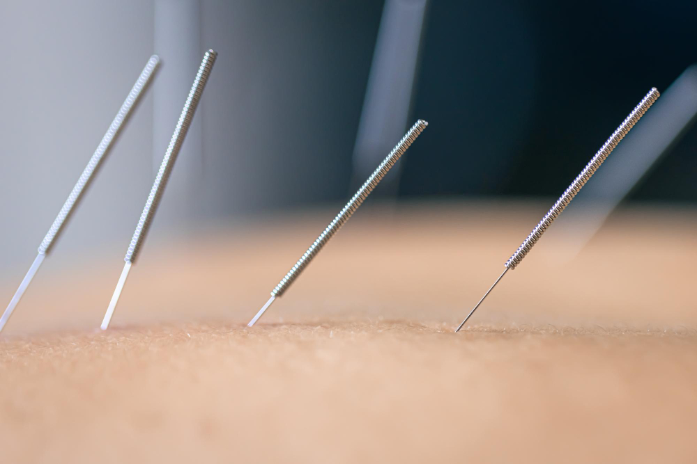 Acupuncture  Gilbert, AZ,