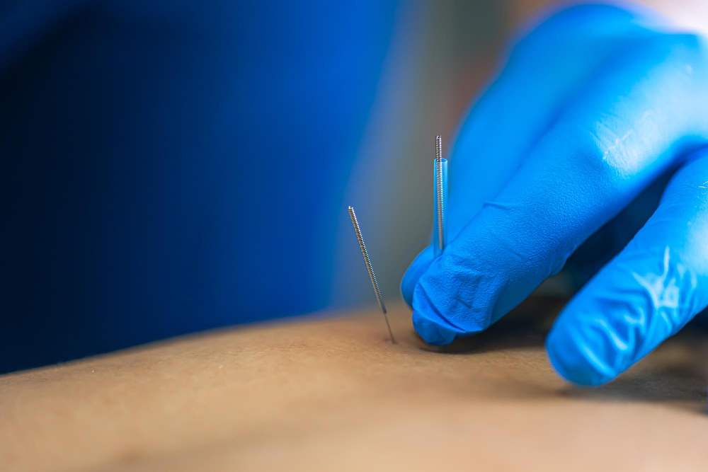 Dry Needling  Gilbert, AZ,
